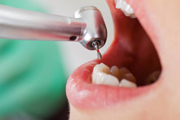Best Lost Filling or Crown Replacement in Mountain Brook, AL